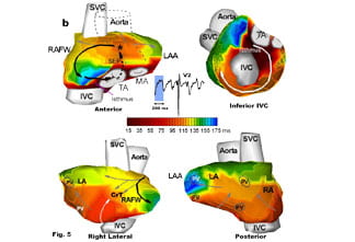 Noninvasive Electrocardiac Imaging of Cardiac Arrhythmias