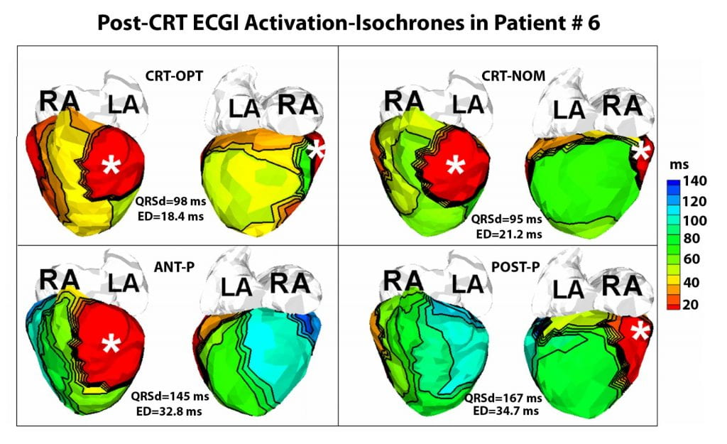 CBAC Electrocardiographic Imaging (ECGI) Retreat